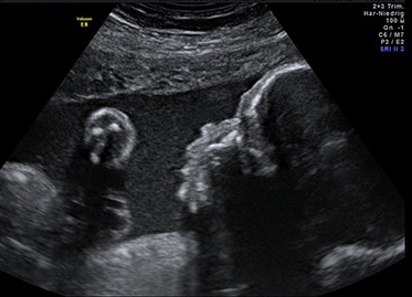 Ultraschall Baby